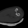 SPORK, NICO - 22.03.1976 - 02.08.2022 - CT obere Extremität - 18:02:23